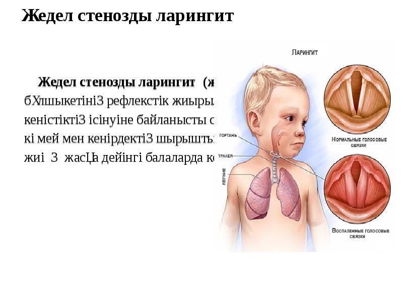 Ларингит у детей. Хронический Лекторский ларингит. Аллергический стенозирующий ларингит. Аллергический ларингит у ребенка.