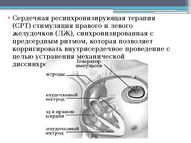 Ресинхронизирующая терапия презентация