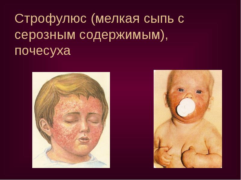 Строфулюс (мелкая сыпь с серозным содержимым), почесуха Строфулюс (мелкая сыпь с серозным содержимым), почесуха