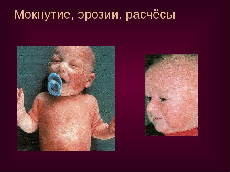 Мокнутие, эрозии, расчёсы Мокнутие, эрозии, расчёсы
