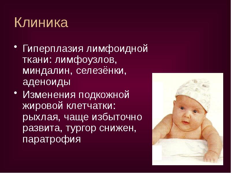 Клиника
Гиперплазия лимфоидной ткани: лимфоузлов, миндалин, селезёнки, аденоиды
Изменения подкожной жировой Клиника
Гиперплазия лимфоидной ткани: лимфоузлов, миндалин, селезёнки, аденоиды
Изменения подкожной жировой