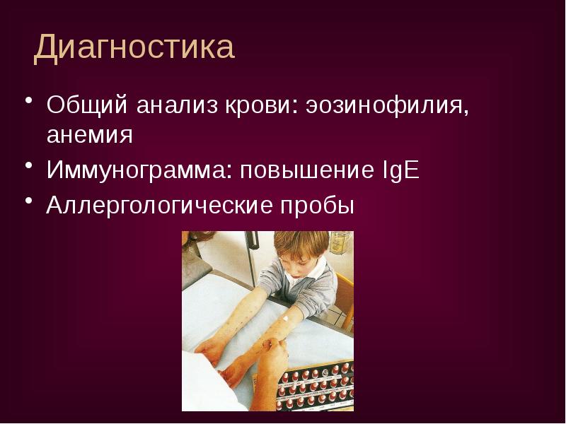 Диагностика
Общий анализ крови: эозинофилия, анемия
Иммунограмма: повышение IgЕ
Аллергологические Диагностика
Общий анализ крови: эозинофилия, анемия
Иммунограмма: повышение IgЕ
Аллергологические