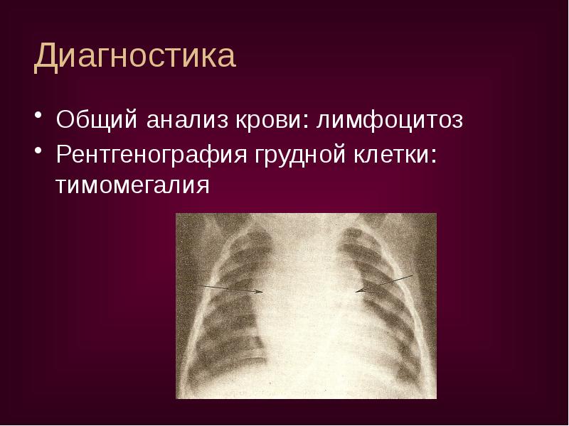 Диагностика
Общий анализ крови: лимфоцитоз
Рентгенография грудной клетки: тимомегалия Диагностика
Общий анализ крови: лимфоцитоз
Рентгенография грудной клетки: тимомегалия