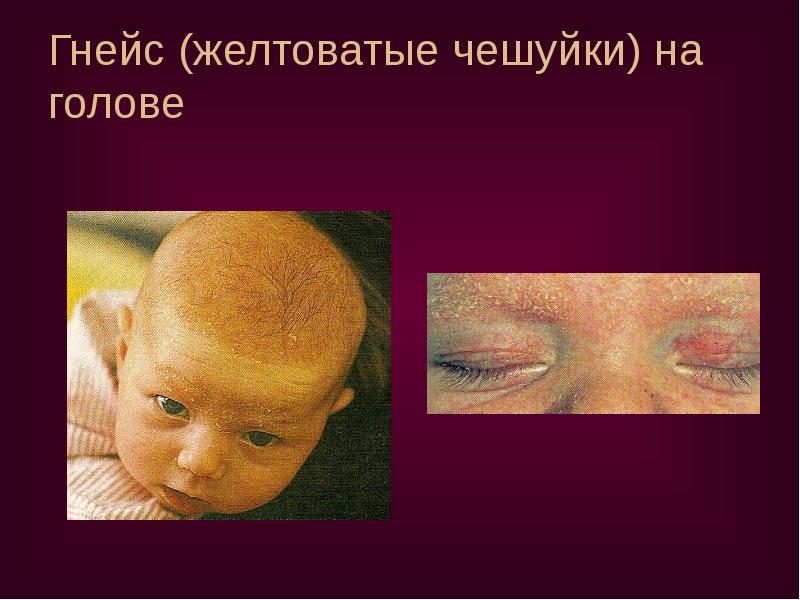 Гнейс (желтоватые чешуйки) на голове Гнейс (желтоватые чешуйки) на голове