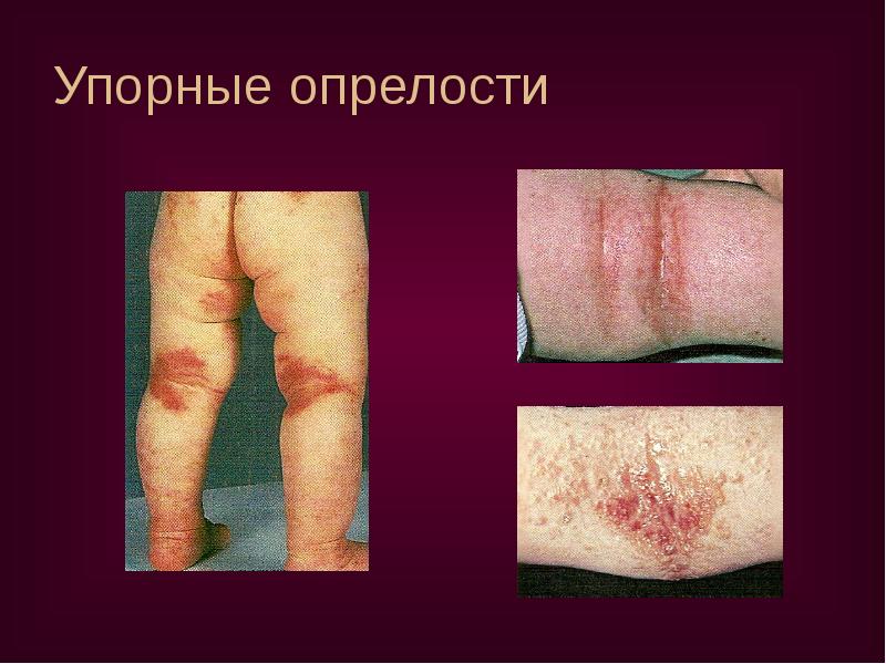 Упорные опрелости Упорные опрелости
