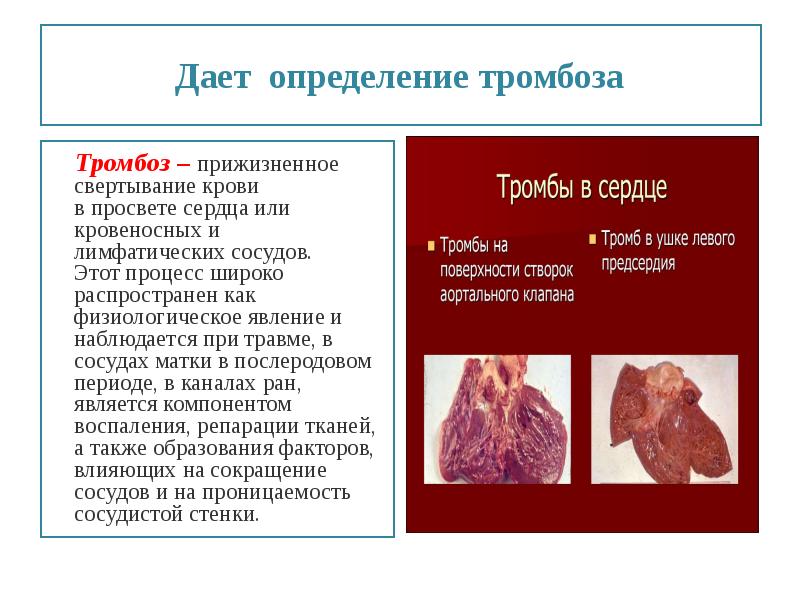 Презентация на тему тромбоз эмболия