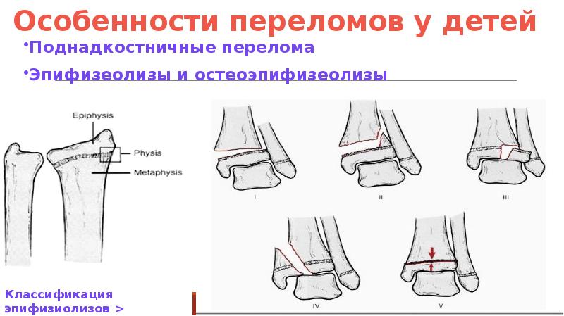 Переломы травматология презентация