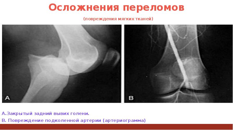 Вывихи травматология презентация