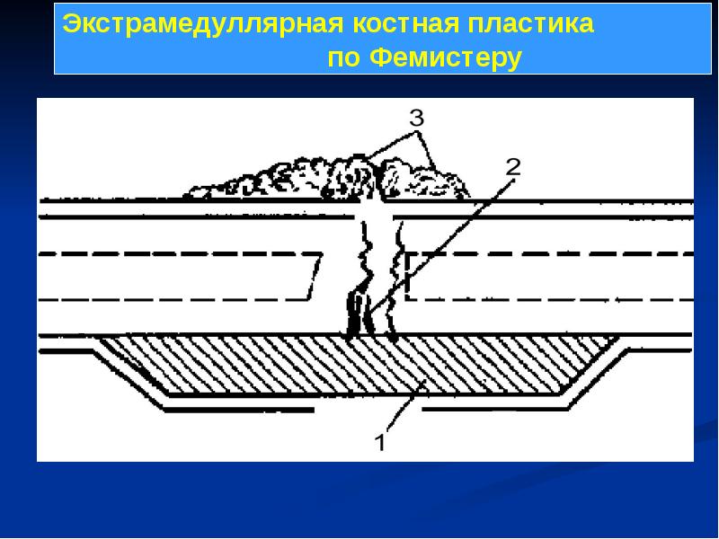 Костная пластика презентация