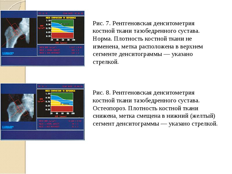 Денситометрия тазобедренного сустава. Остеоденситометрия рентген расшифровка. Расшифровка денситометрии бедренной кости. Денситометрия заключение остеопороз. Показатели плотности костей денситометрии.