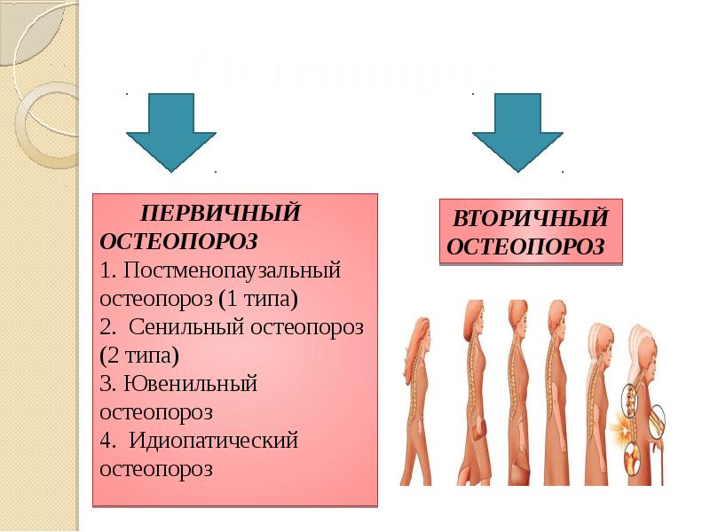 Вторичный остеопороз. Первичный и вторичный остеопороз. Типы остеопороза. Формы вторичного остеопороза.