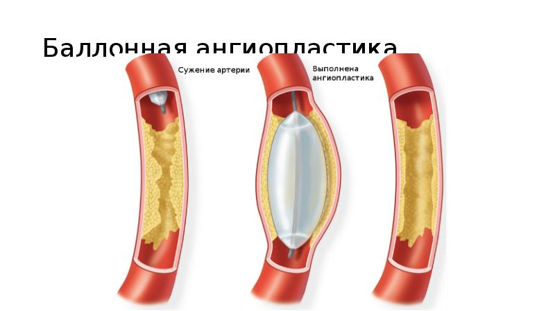 Баллонная ангиопластика артерий. Субинтимальная ангиопластика. Лазерная ангиопластика. Реваскуляризация сосудов. Реваскуляризация конечности.