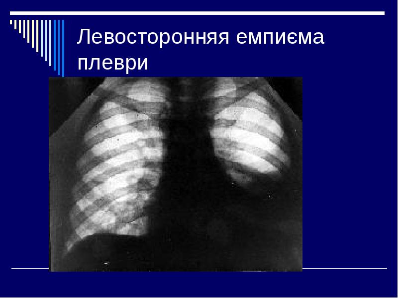 Плевра эмпиемасы презентация казакша