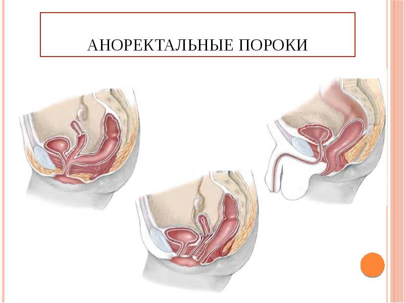 Атрезия заднего прохода и прямой кишки презентация