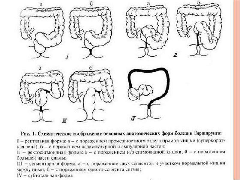 Схема изменений толстой кишки при болезни гиршпрунга