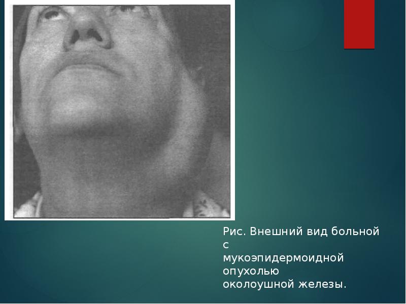 Рис. Внешний вид больной с мукоэпидермоидной опухолью околоушной железы. Рис. Внешний