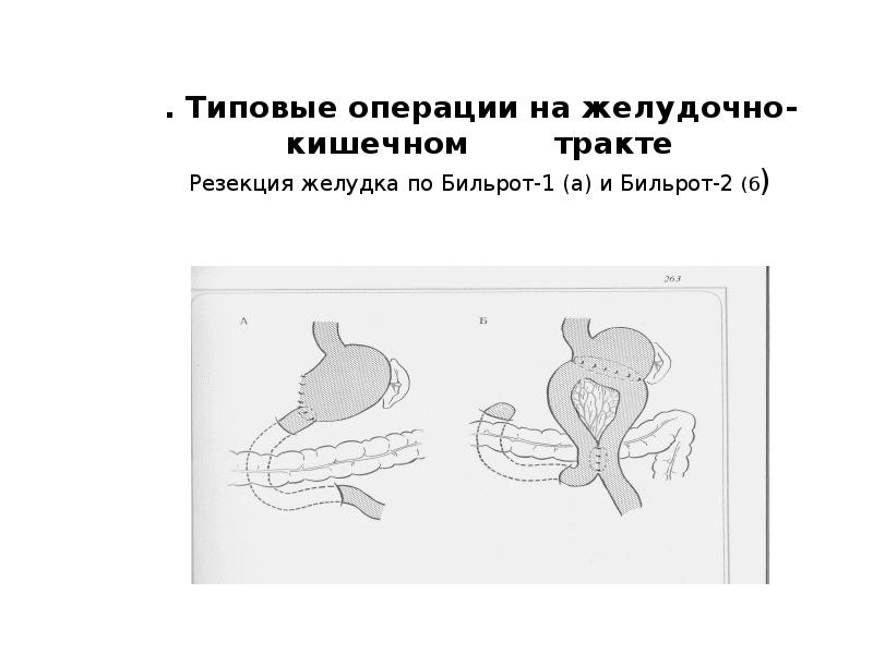 Операция резекция желудка. Операции на желудке и кишечнике. Резекция желудка по Бильрот презентация.