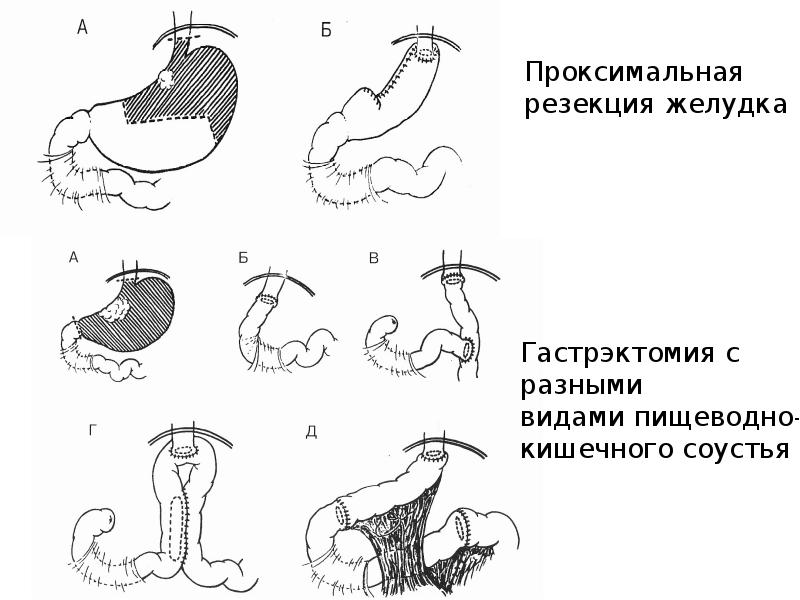 Резекция желудка по бальфуру схема