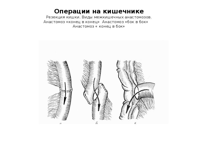 Кишечные анастомозы презентация