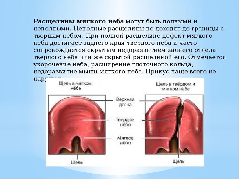 Обозначьте на рисунке виды расщелин