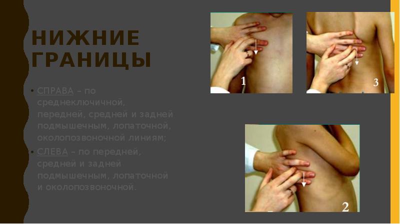 Нижние границы
СПРАВА – по среднеключичной, передней, средней и задней подмышечным, Нижние границы
СПРАВА – по среднеключичной, передней, средней и задней подмышечным,