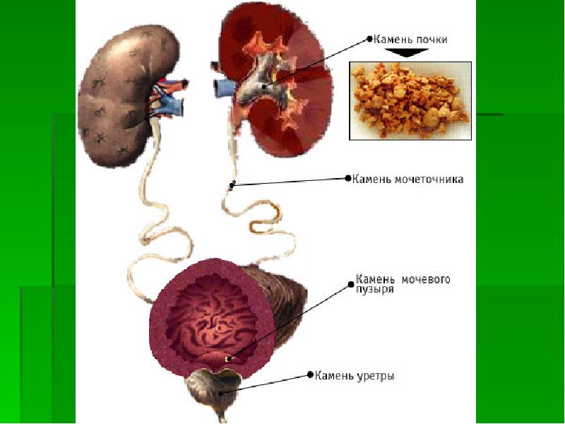 Схема выхода камня из почки у мужчин