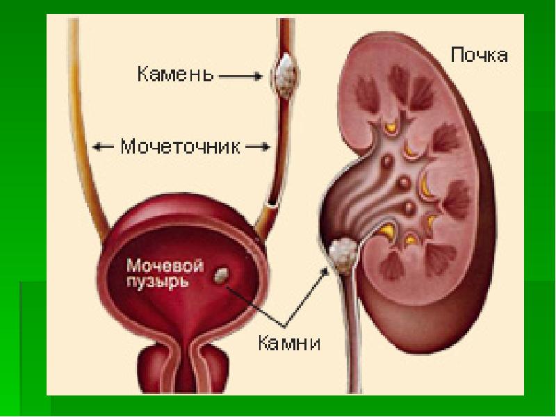 Просвет мочеточника