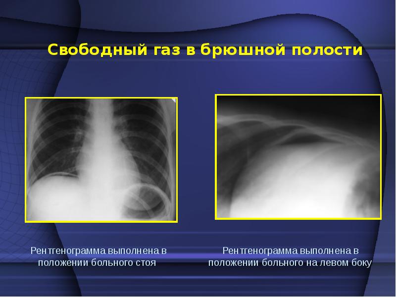 Свободный газ. Перфорация язвы желудка рентгенограмма. Свободный ГАЗ В брюшной полости рентген. Свободный ГАЗ под куполом диафрагмы рентген. Рентген при прободной язве.