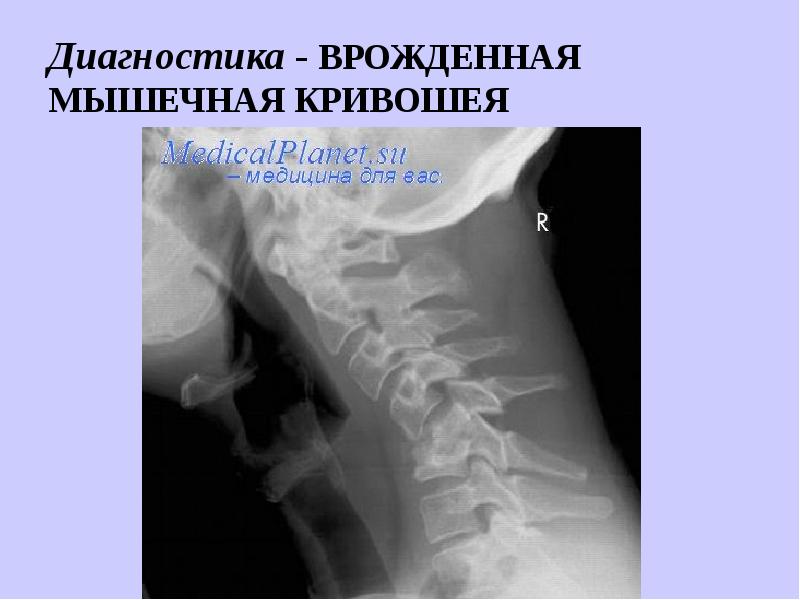 Врожденная кривошея травматология презентация