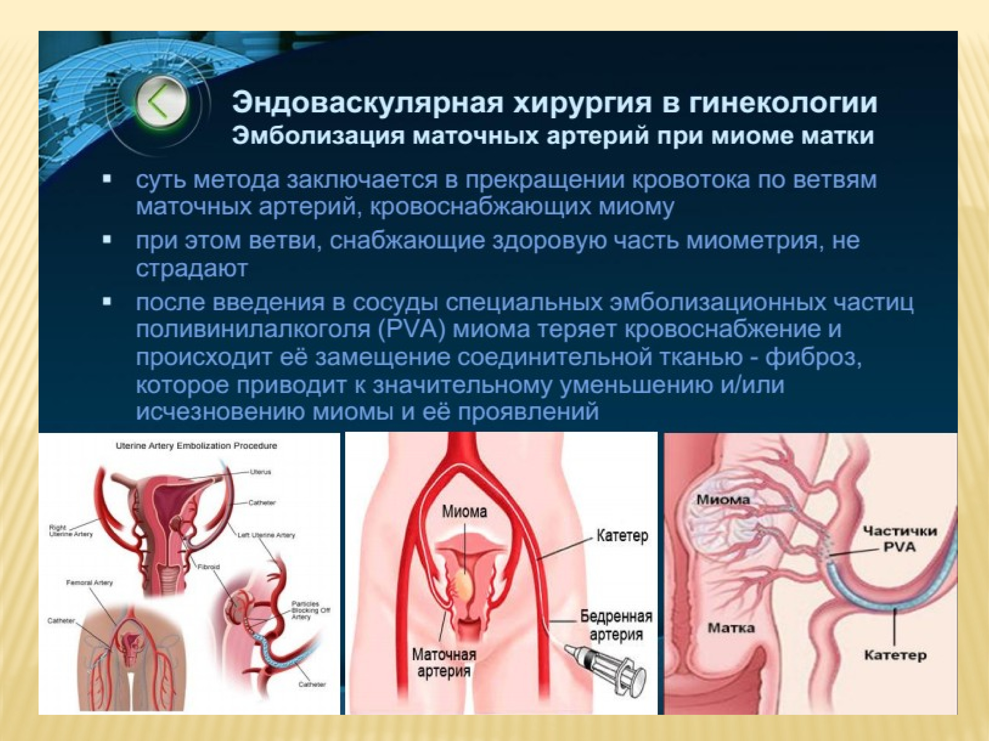 Эмболизация маточных артерий. Эндоваскулярная эмболизация маточных артерий. Эмболизация маточных вен. Эмболизация артерий методика. Эмболизация сосудов матки.