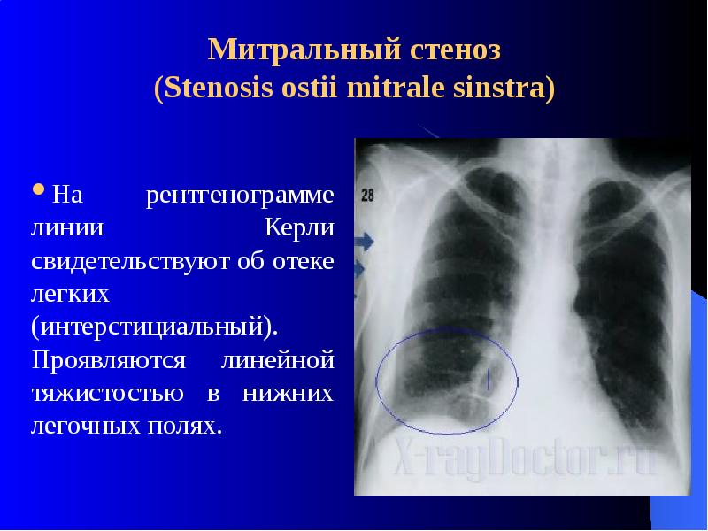 Митральная стеноз презентация