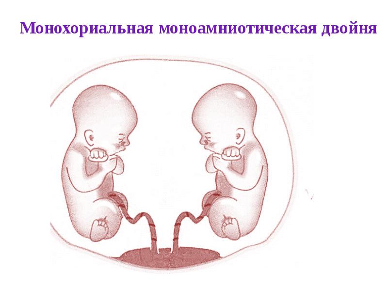 Многоплодная беременность презентация