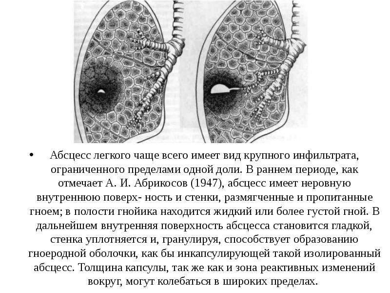 Абсцесс легкого презентация