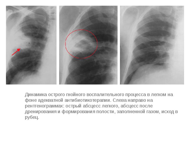 Абсцесс легкого презентация