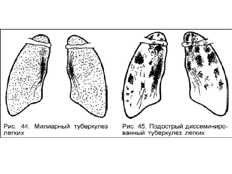 Милиарный туберкулез презентация