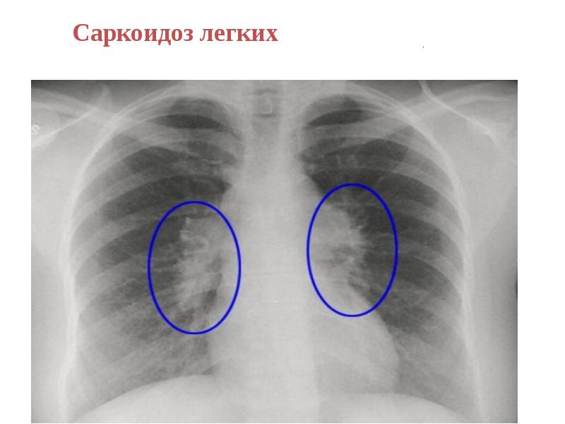 Саркоидоз фтизиатрия презентация