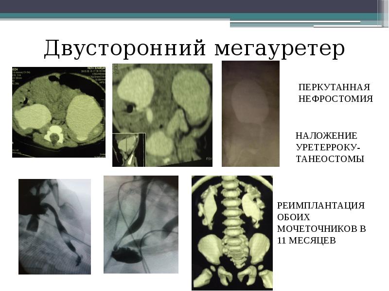 Мегауретер у детей презентация