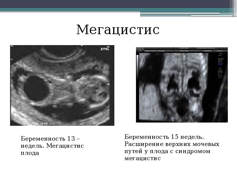 ультразвуковое исследование мочевого пузыря трансабдоминальное. узи при беременности на полный мочевой. трансабдоминальное узи мочевого пузыря.