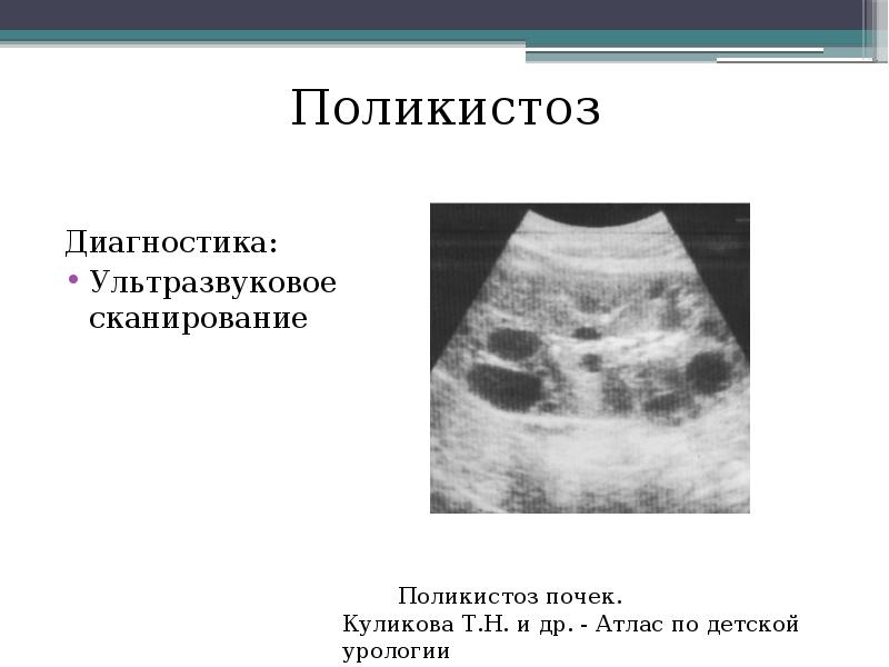 Поликистоз почек на узи. Поликистоз почек УЗИ протокол. Поликистоз почек на УЗИ описание. Поликистоз почек УЗИ заключение.