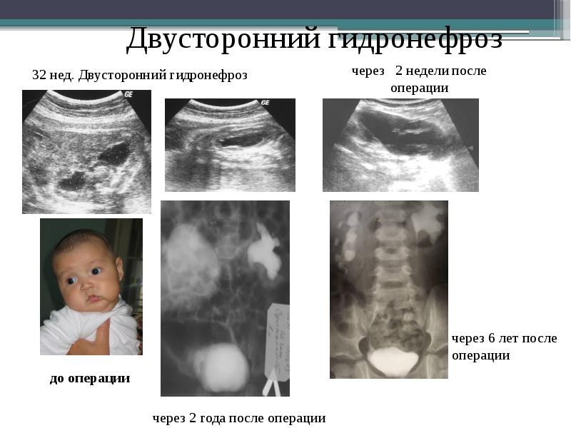 Гидронефроз презентация урология