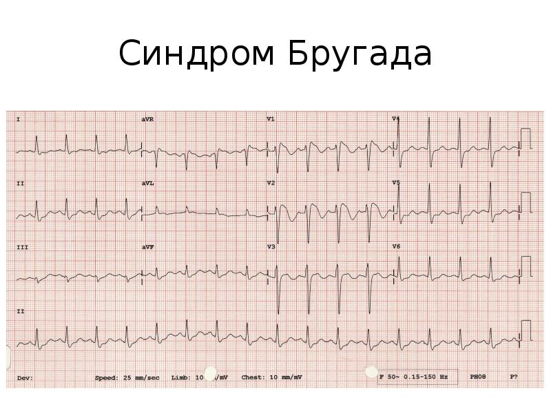 Синдром бругада на экг фото