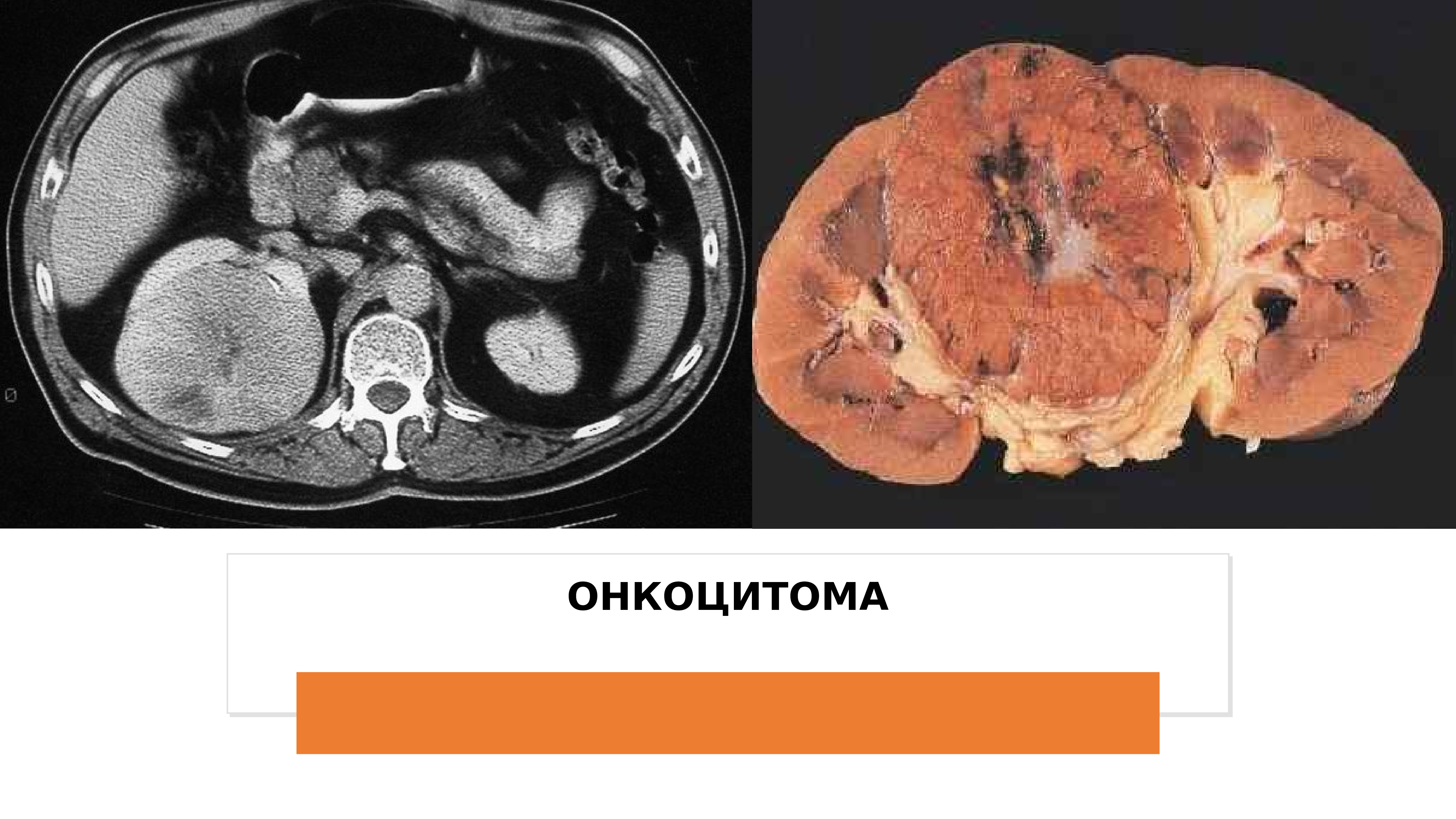 Рак почки картинки