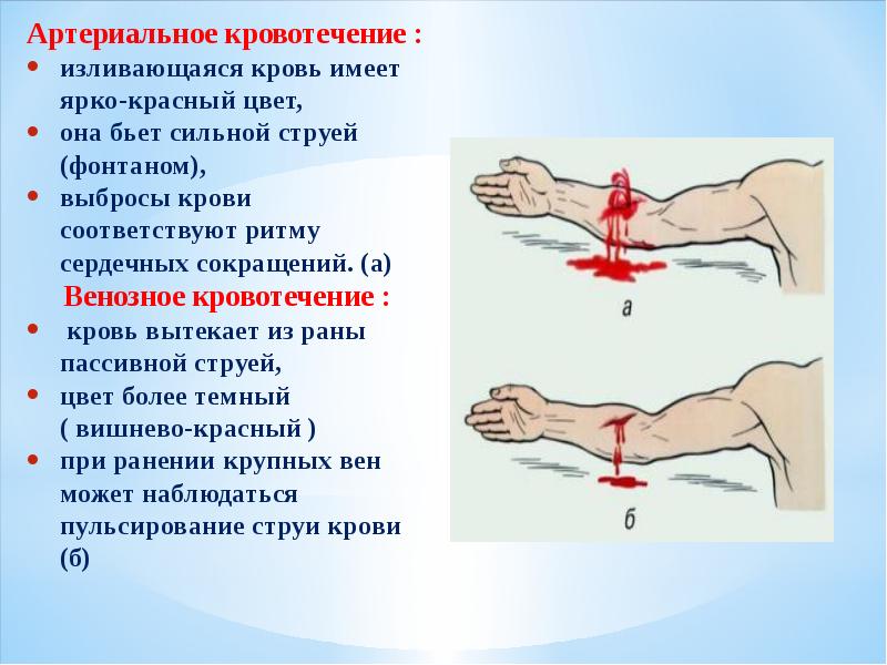 Методы временной остановки кровотечения картинки