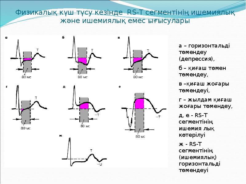 Физикалық күш түсу кезінде RS-T сегментінің ишемиялық және ишемиялық емес ығысулары