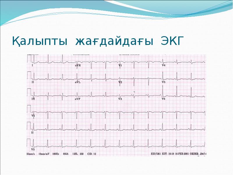 Қалыпты жағдайдағы ЭКГ