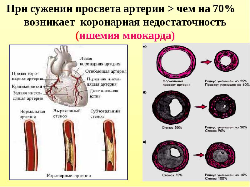 Стеноз сонно. Стеноз просвета коронарных артерий. Стеноз венечных артерий. Сужение просвета артерий.