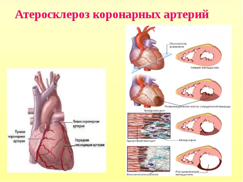 Атеросклероз артерий сердца