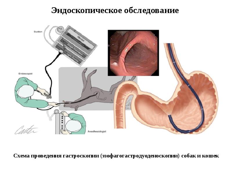 Операция зонд. ЭГДС двенадцатиперстной кишки. Гастроскопия желудка гастрит. Эндоскопическое исследование желудка и двенадцатиперстной кишки.