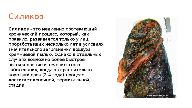 Силикоз Силикоз - это медленно протекающий хронический процесс, который, как правило,