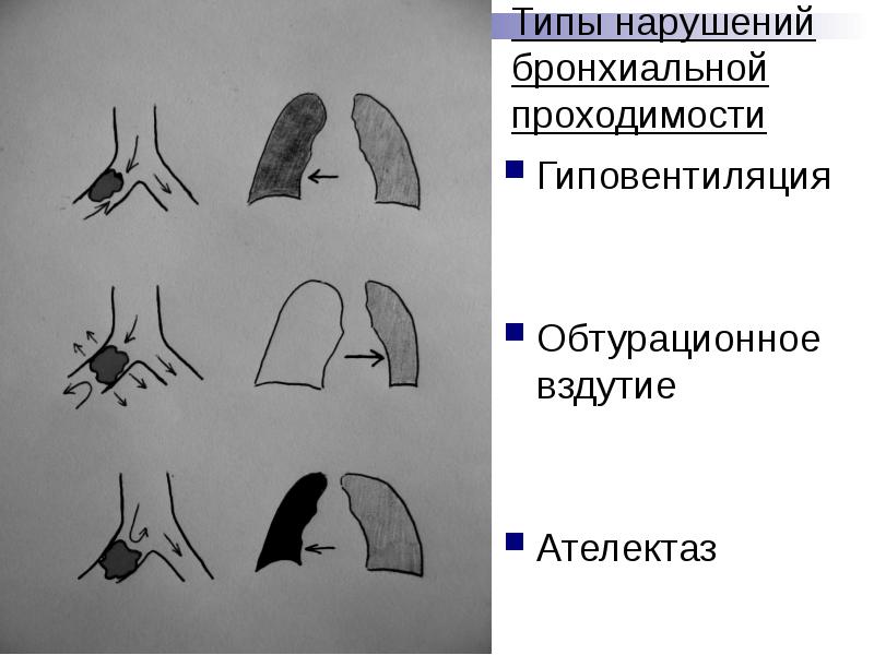 Ателектаз схема легких